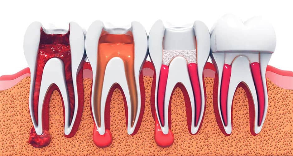 Root Canal Treatment in Calgary